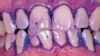 Picture of Bioclear Dual Colour Disclosing Solution