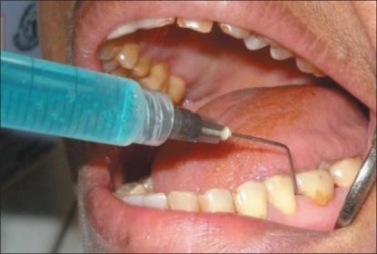 Picture of Hexachlor 2% Chlorhexidine Diigluconate Solution SafeEndo