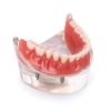 Picture of Teeth Model With Dental Disease Restoration Bridge Implant